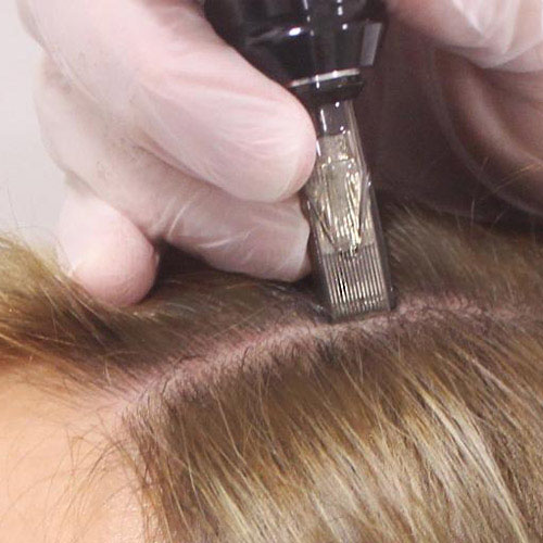 dermatologista-em-juiz-de-fora-procedimento-Microinfusao-aberto