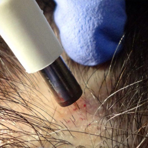 dermatologista-em-juiz-de-fora-procedimento-biopsia-aberto