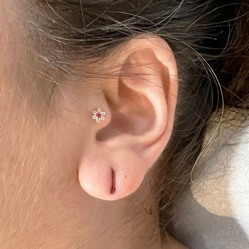 dermatologista-em-juiz-de-fora-procedimento-lobuloplastia