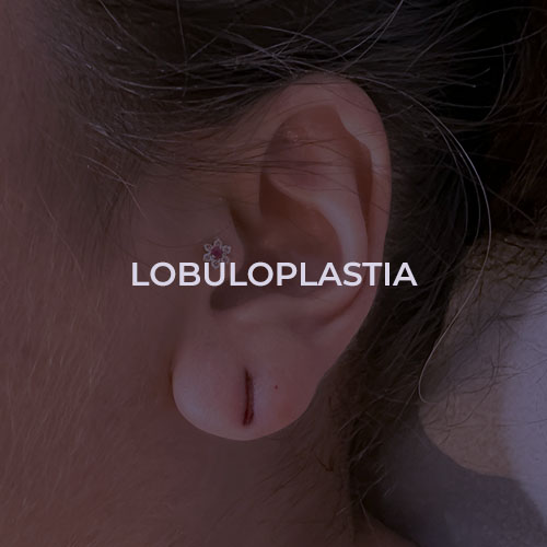 dermatologista-em-juiz-de-fora-procedimento-lobuloplastia1